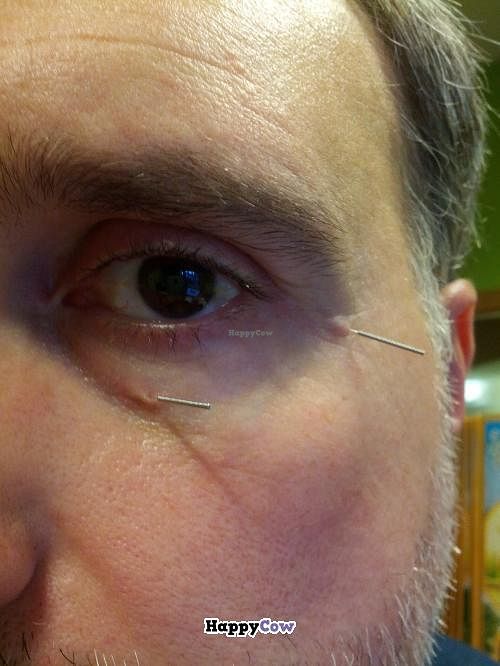 More on accupuncture at El Druida y Las Hierbas in Palencia